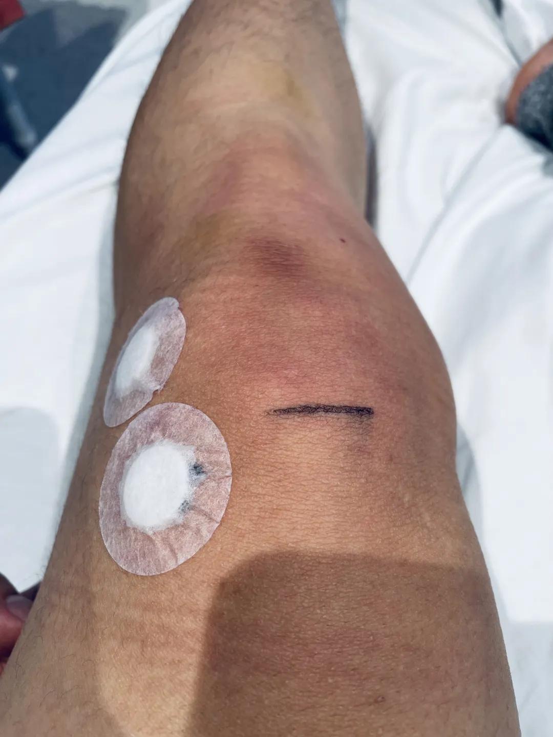 骨科主任来临终关怀科查房,把我转到了风湿免疫科……