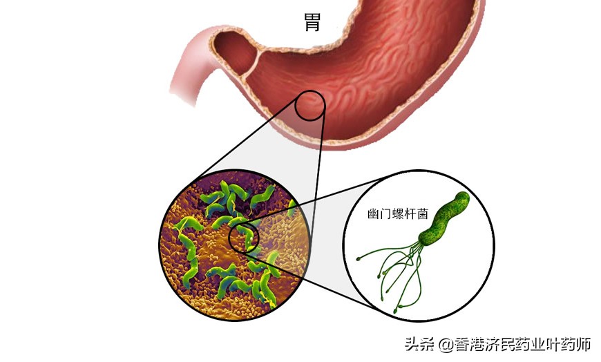 抗幽门螺杆菌6种抗生素的组合,幽门螺杆菌根除适应症2007共识