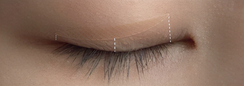 肿眼皮双眼皮贴正确的贴法,双眼皮贴干货