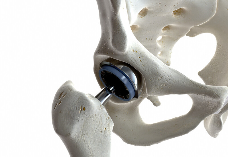 髋关节置换术后可以坐轮椅吗,人工置换髋关节多久可正常行走