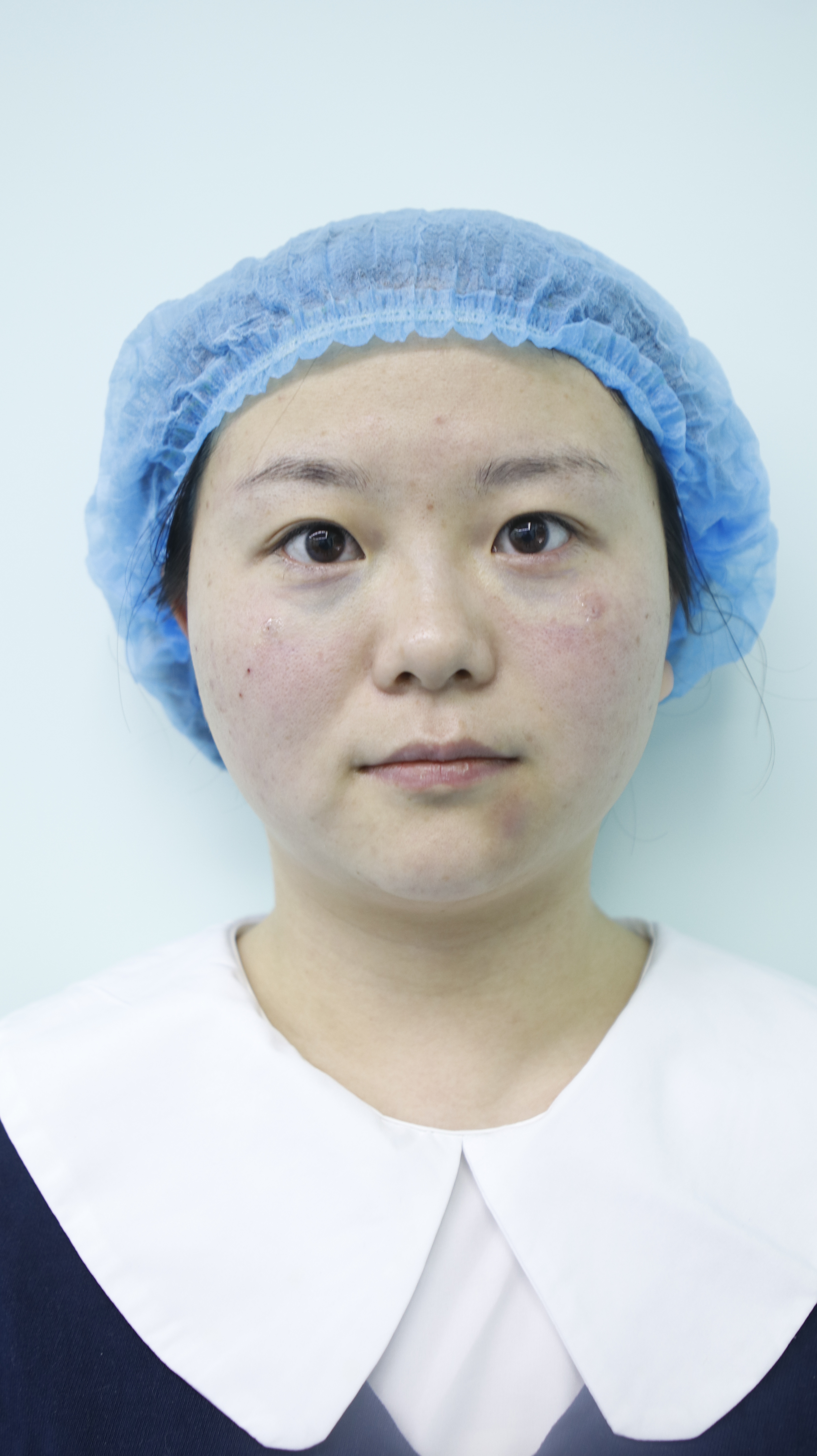 10年后去不掉的眼袋,年轻时的眼袋是怎么样的