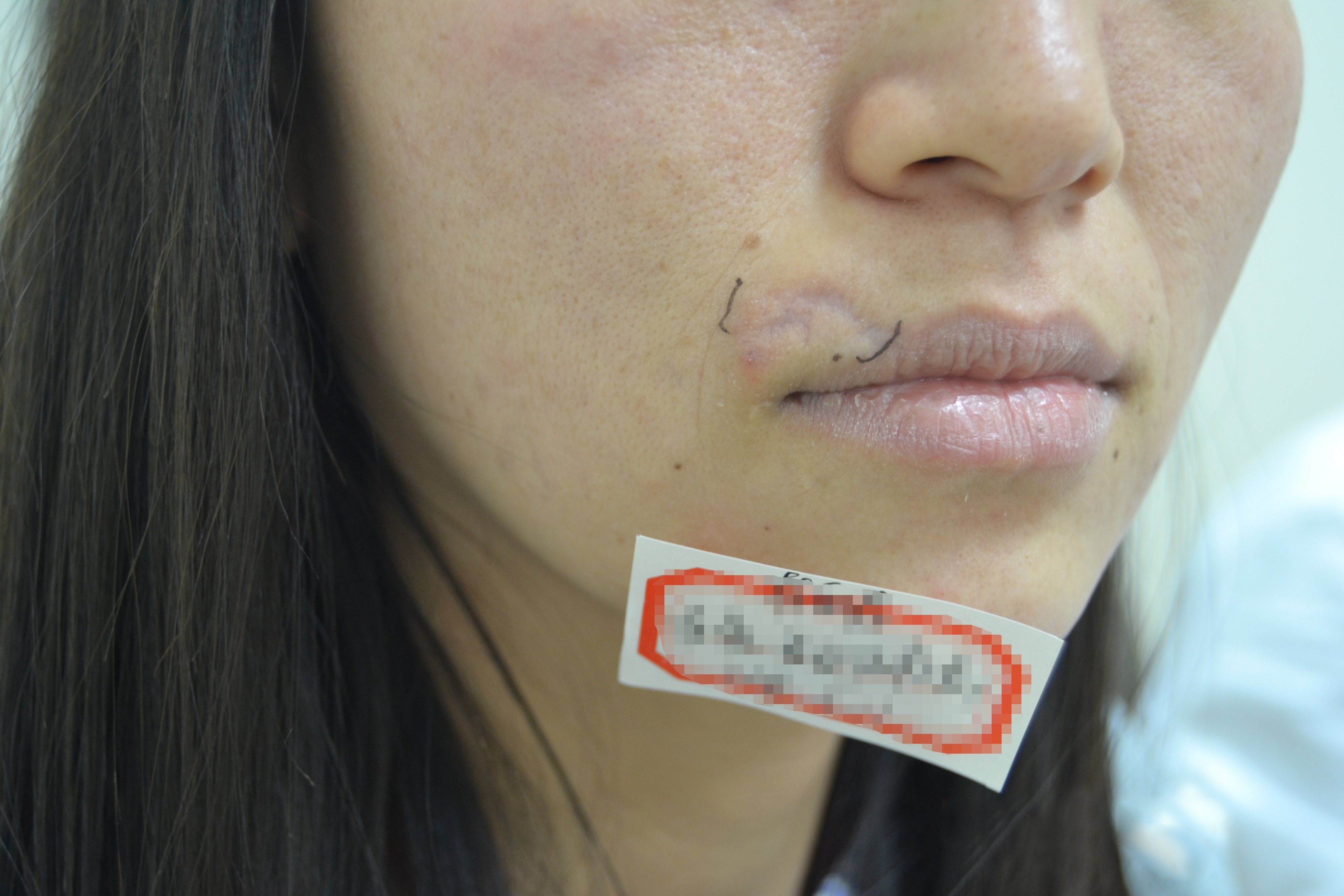 郑州哪家医院治疗凹陷疤痕,郑州疤痕医院治疗凹陷疤痕费用