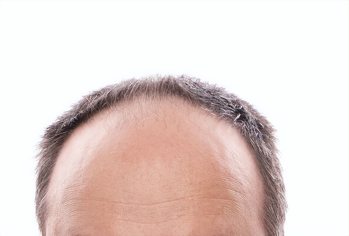 你的发际线,你的发际线在后移