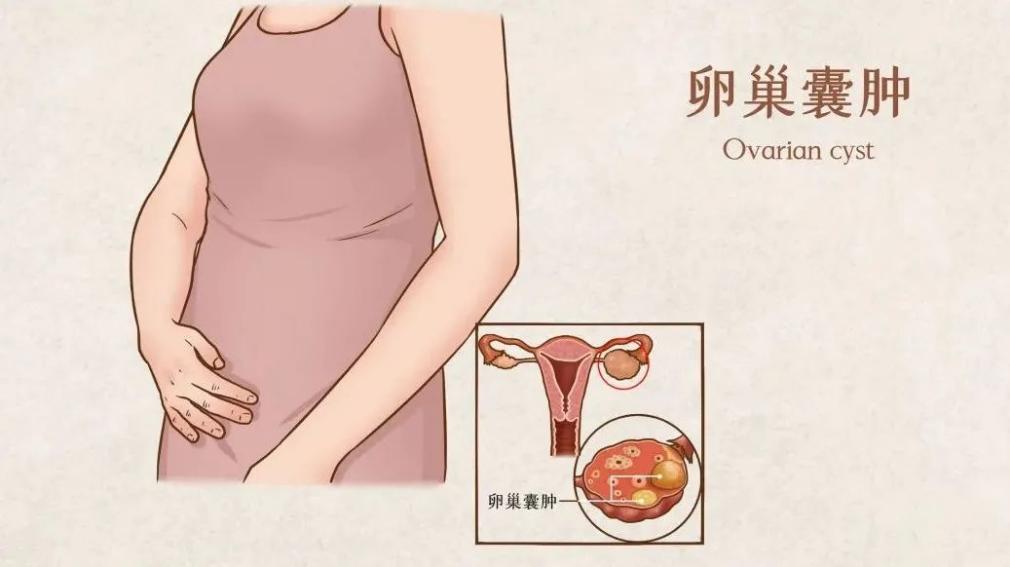 卵巢巧克力囊肿手术影响怀孕吗,卵巢囊肿腹腔镜手术后多久能怀孕
