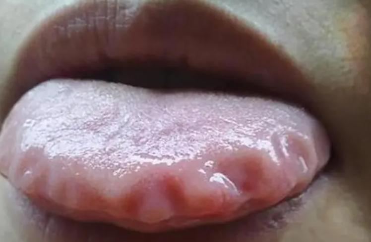 六经辨证治疗萎缩性胃炎,脾胃不好萎缩性胃炎如何调理