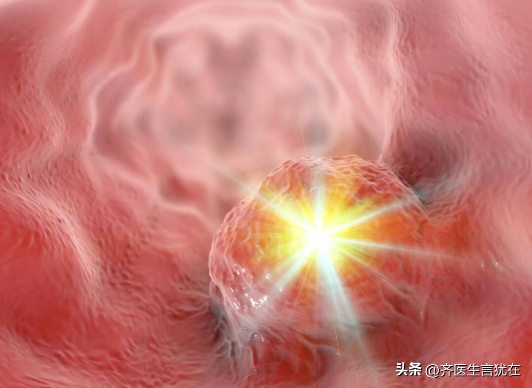 微球钇90治疗肝癌适合什么人,钇90微球能根治肝癌晚期吗