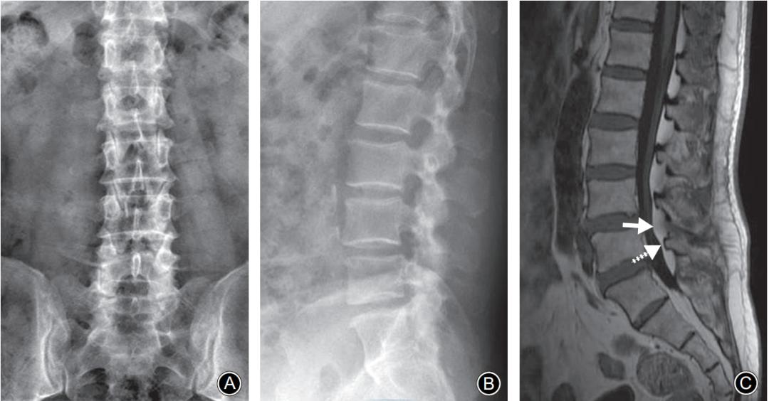 轻度峡部裂和重度峡部裂的区别,真性峡部裂和假性峡部裂