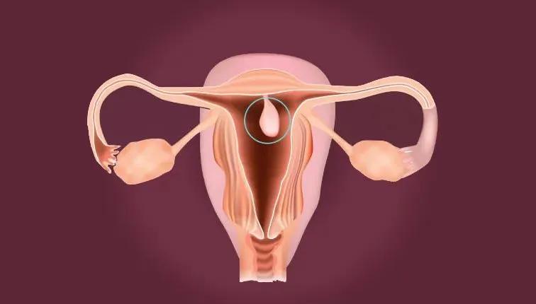 哪些息肉本来就会长的,容易癌变的息肉有哪些