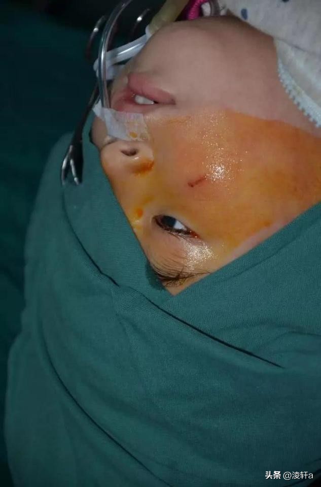 8岁男孩20分钟后眼球融化,男童眼球瞬间被融化