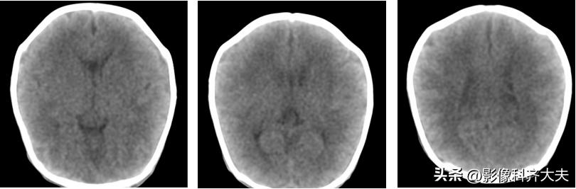 新生儿缺氧缺血性脑病的mr诊断,新生儿缺血缺氧脑病的ct表现