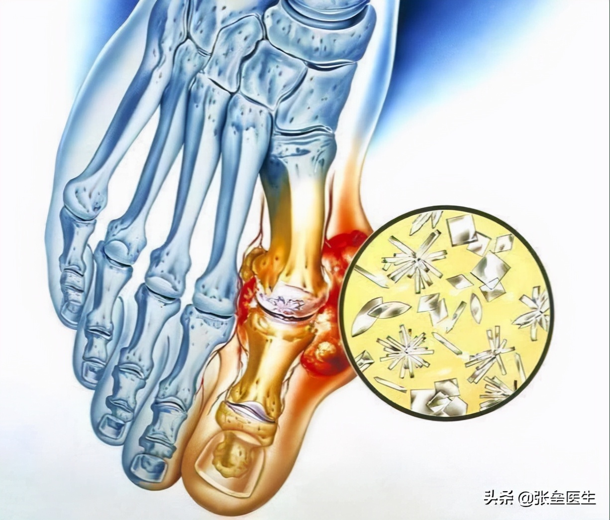 关节痛不要盲目判断滑膜炎,关节疼怎么判定是不是痛风
