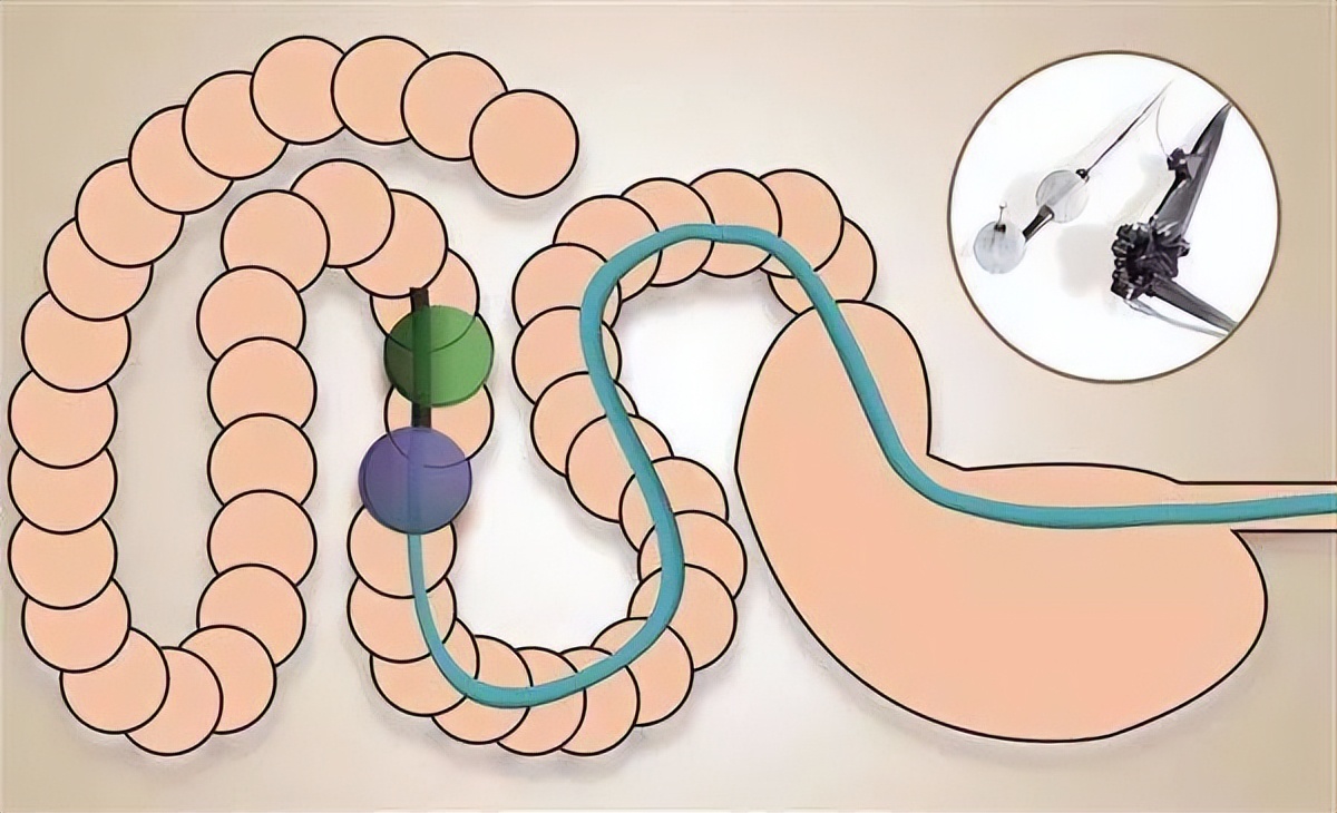 为什么大多数人不想做胃肠镜,为什么大多人不想做胃肠镜