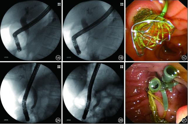 全覆膜自膨式金属支架和多根塑料支架治疗良性胆管狭窄的对比研究