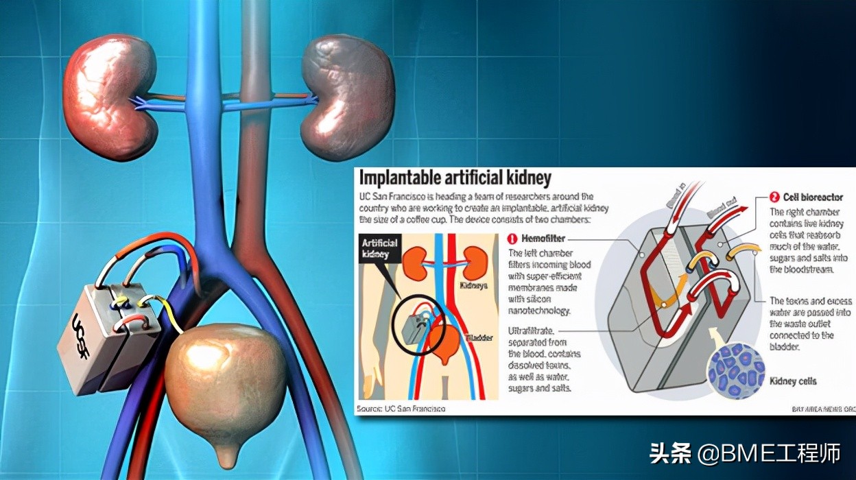 终末期肾病（尿毒症）的临床方案——人工肾脏的未来