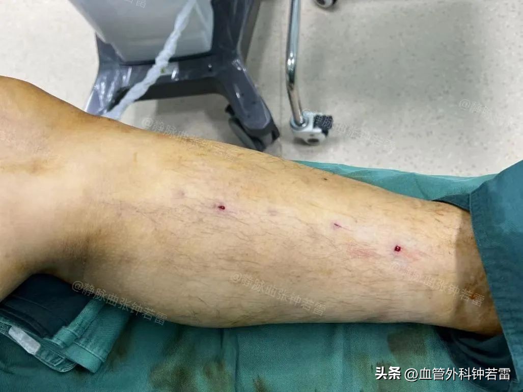 浙江39岁崔先生脚上“破了个洞”千里寻医验证联合微创科学方法！