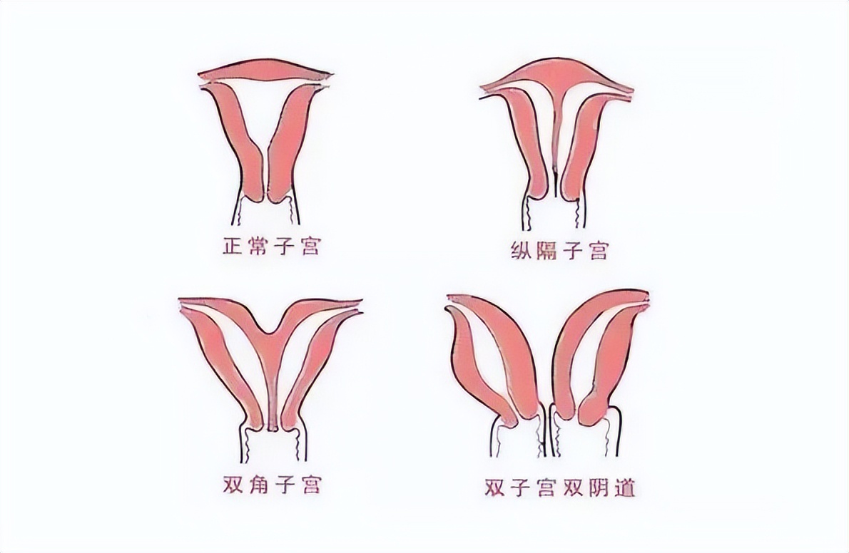 不全纵隔子宫y型能正常怀孕吗,子宫不全纵隔0.6厘米需要动手术么