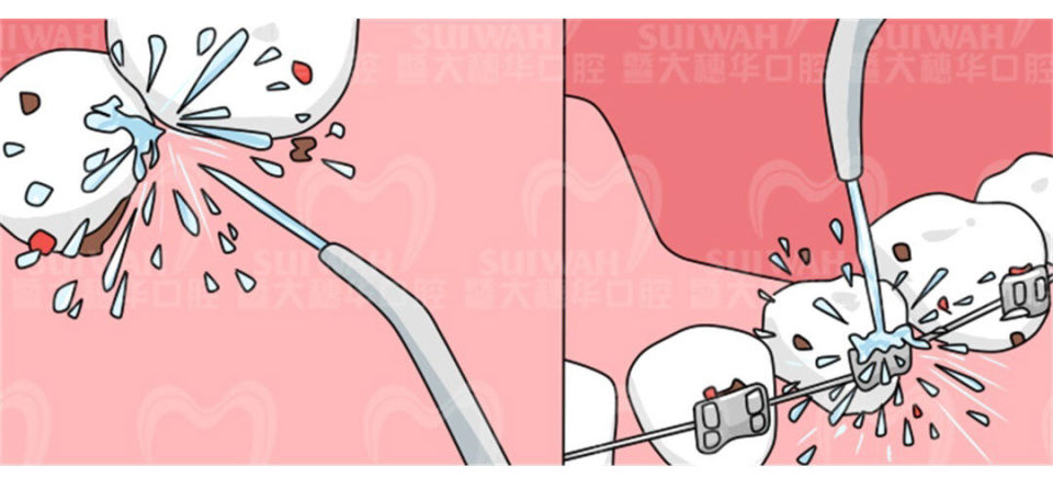 戴牙套总是有口腔溃疡怎么办,戴牙套总是长口腔溃疡怎么办