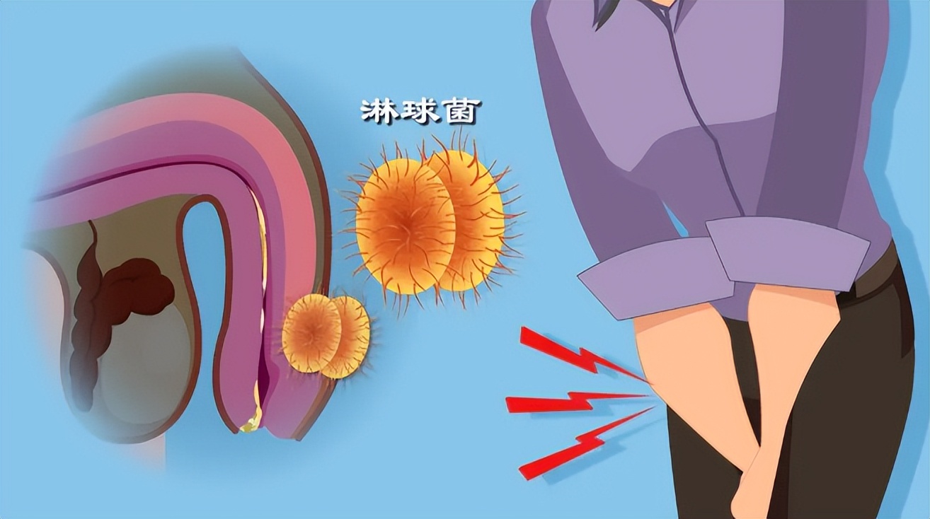 男人得了淋病会有什么症状？