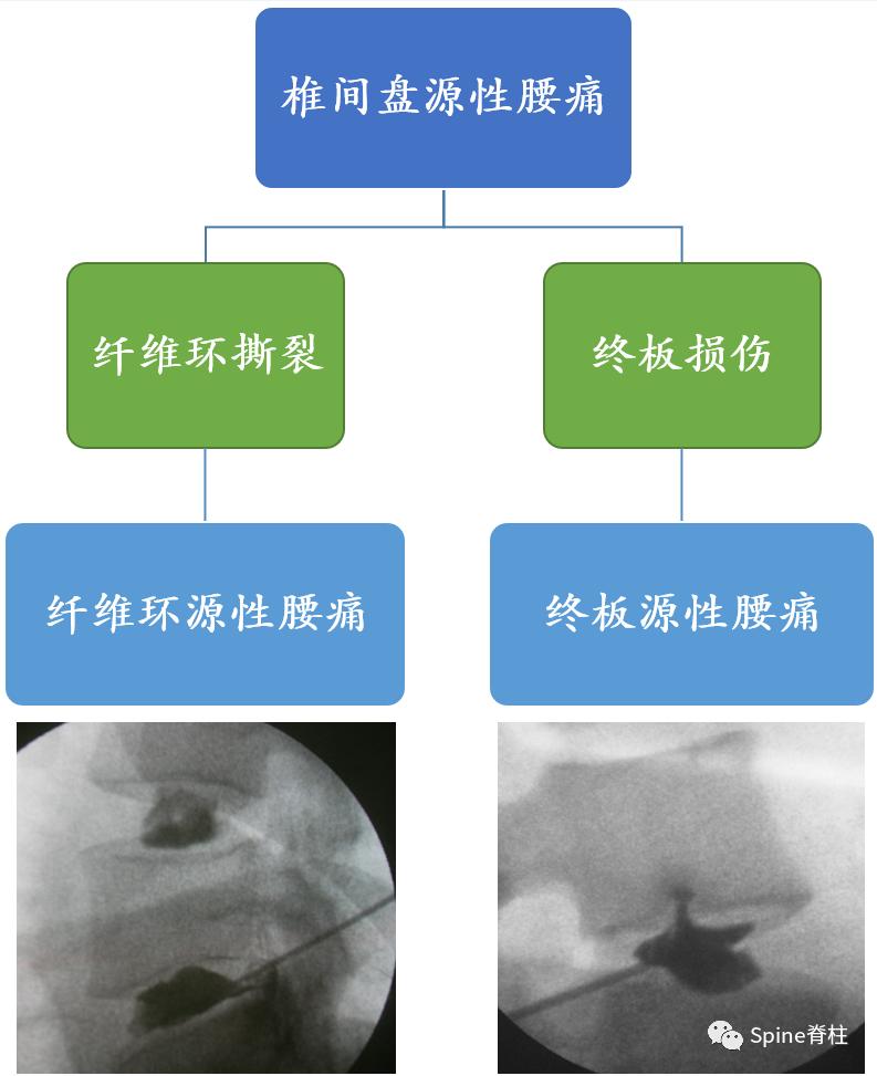 因腰椎问题导致的腰痛,慢性腰骶部疼痛
