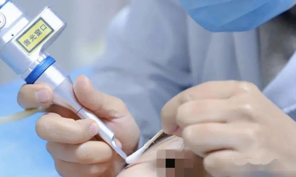 激光整形科,神秘之光激光