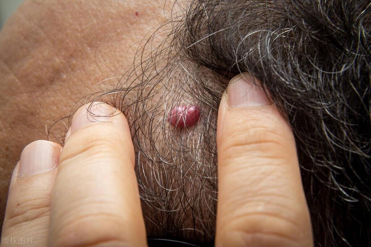 皮肤长“小肉球”是怎么回事,可以抠掉吗?一文说清
