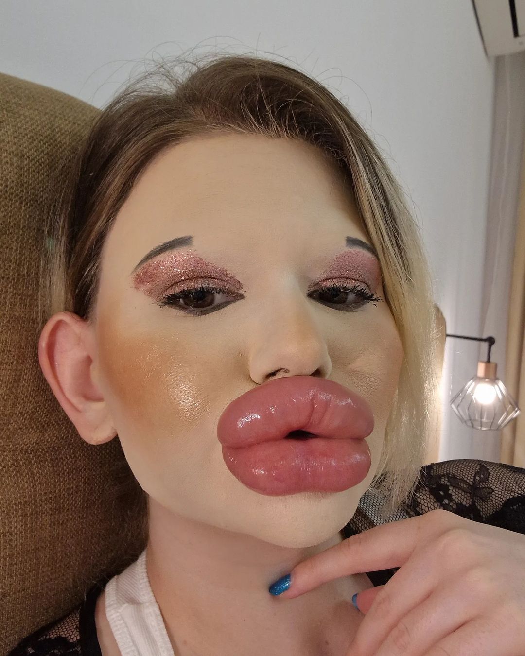 女子狂打30支玻尿酸,丰唇针建议打吗