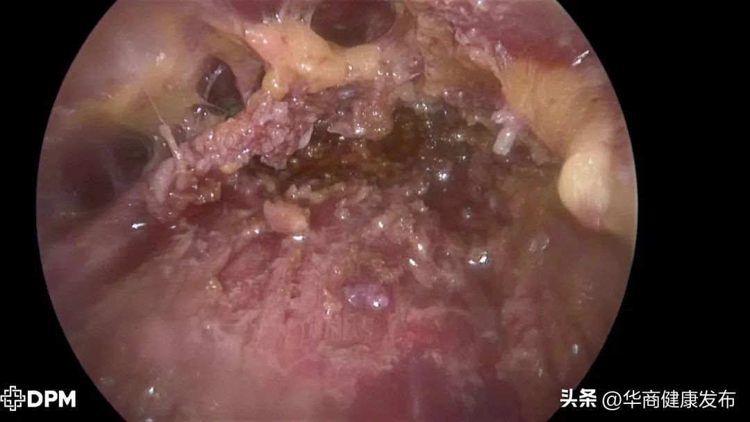 微创腹腔镜是什么,腔镜手术皮下隧道恢复时间