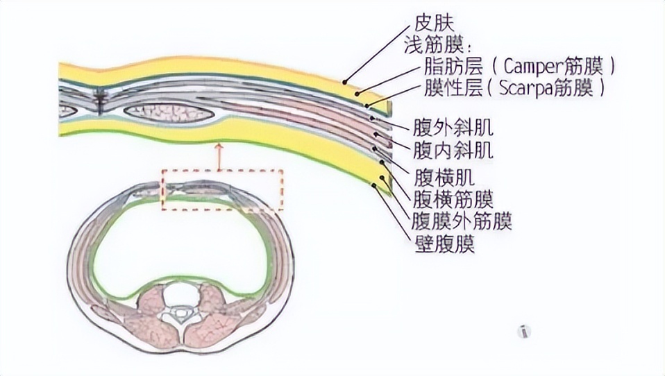 腹部松弛的女性是生过小孩的吗,腹壁松弛是因为肚子太大吗