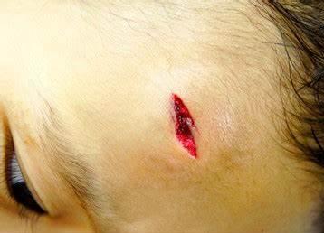 缝合后凹陷疤痕怎么修复儿童,儿童凹陷性疤痕彻底修复方法