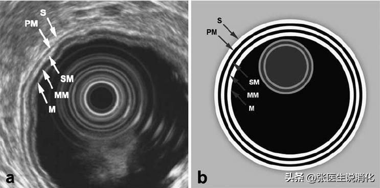 胃粘膜下肿物是什么意思,胃黏膜下肿物是癌症吗