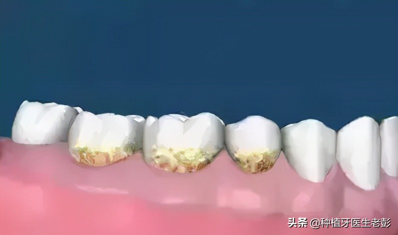 咨询医生治疗牙周炎,我想种植牙