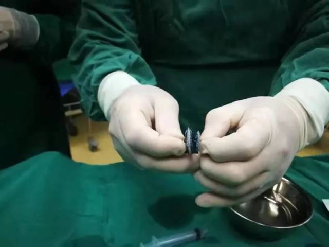 卵圆孔未闭介入封堵治疗前庭性偏头痛的疗效分析