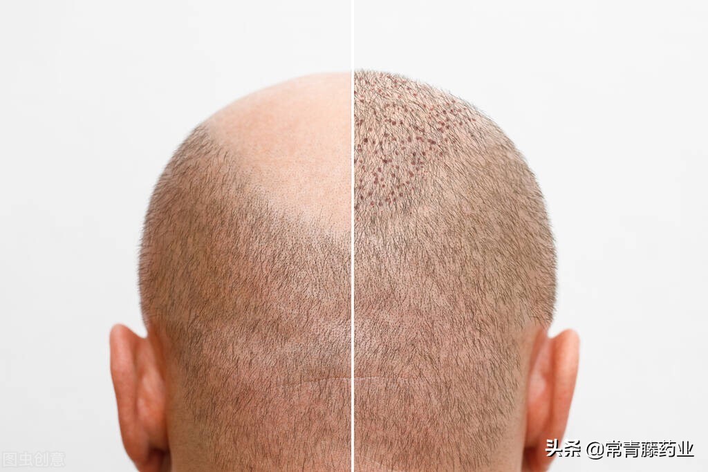 什么人适合植发做发际线,植发可靠吗值不值得植发