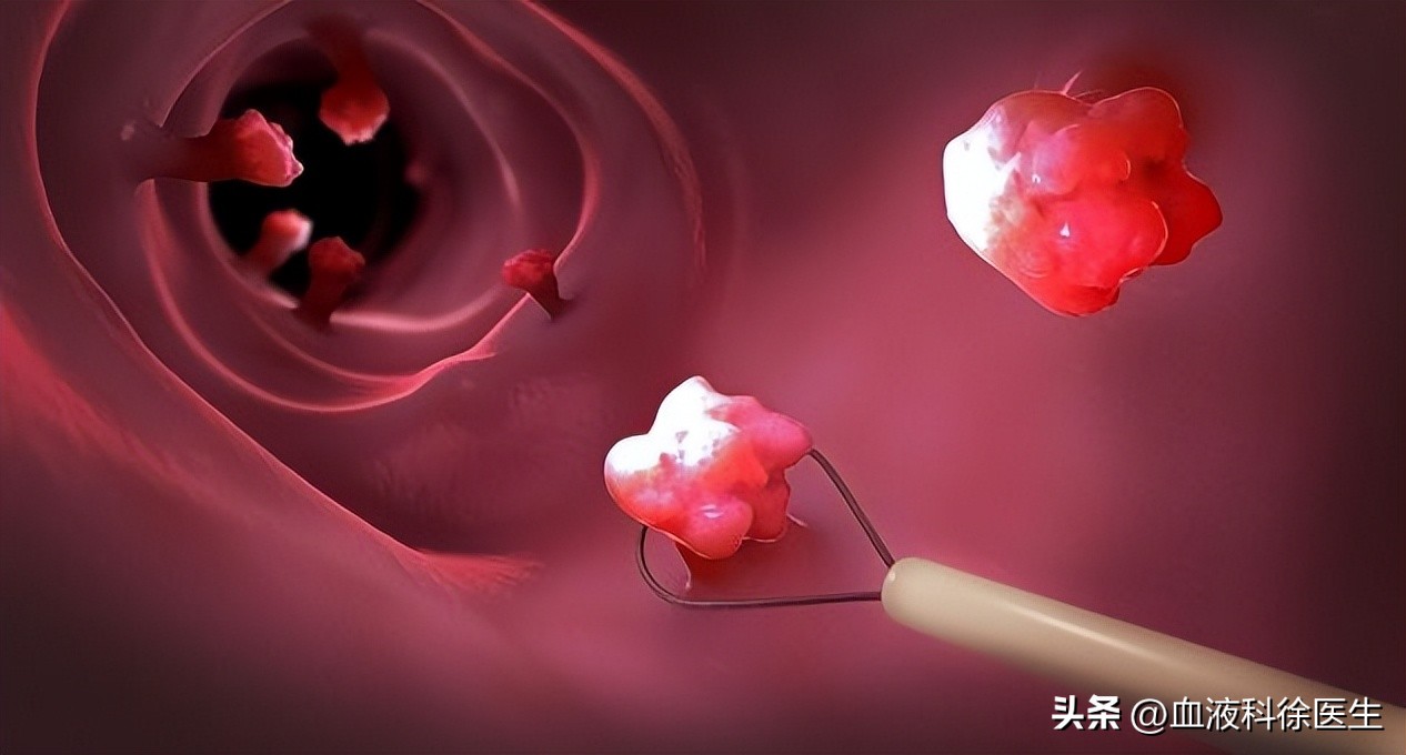 “难以启齿”的肛门病，你了解吗？下身有这3种异常，早做检查！