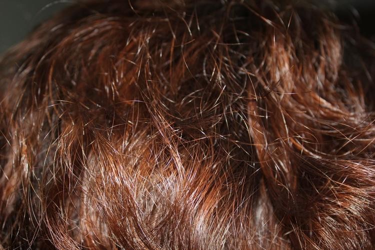 加快黑色素代谢的维生素,毛发黑色素少如何增加黑色素