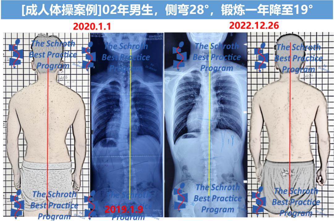 成人脊柱侧弯往哪弯,成年人脊柱侧弯怎么矫正