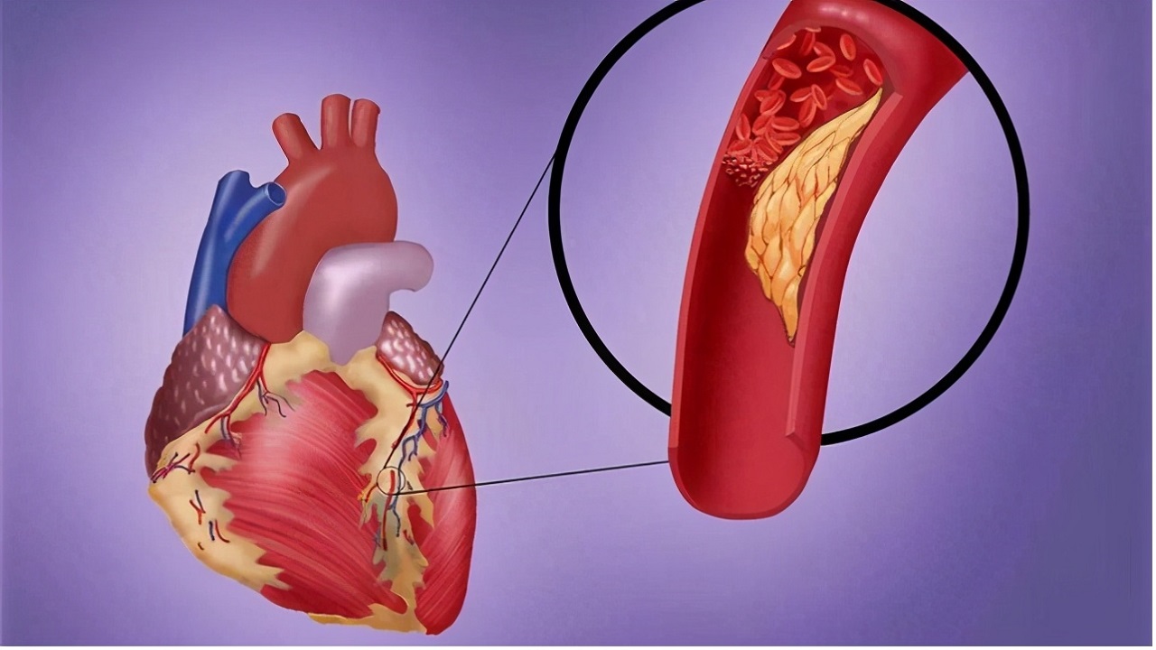 一招教你辨别胸口疼是不是心脏病,右乳房靠近胸口处刺痛是心脏病吗