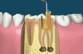 吃冷热都牙痛是哪种牙病,牙痛除了蛀牙还有什么原因