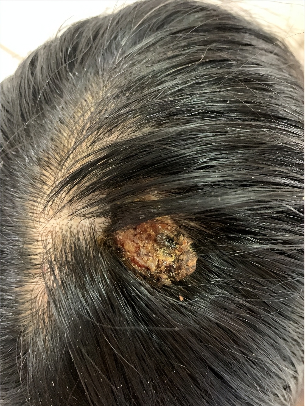 头上长了红色斑要注意了,头上有斑块怎么治