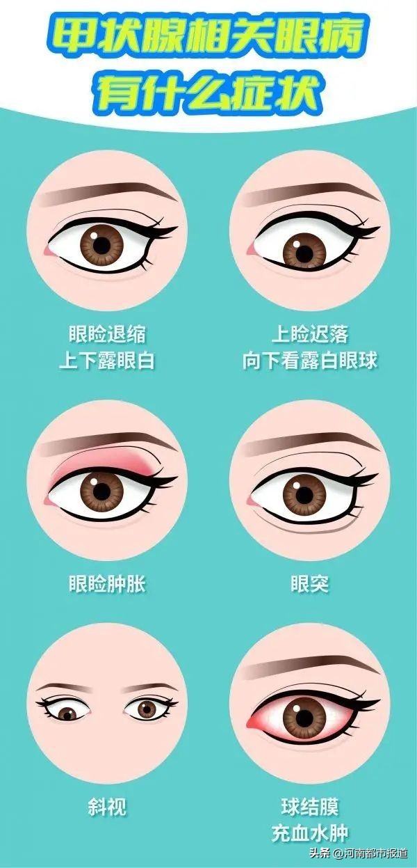眼睛有重影是新冠症状吗,新冠肺炎会不会眼睛重影现象