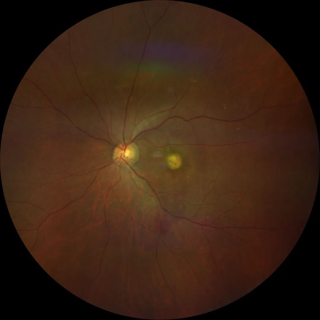 视力模糊眼前有黑影,眼前看到黑影滚动视力差怎么回事