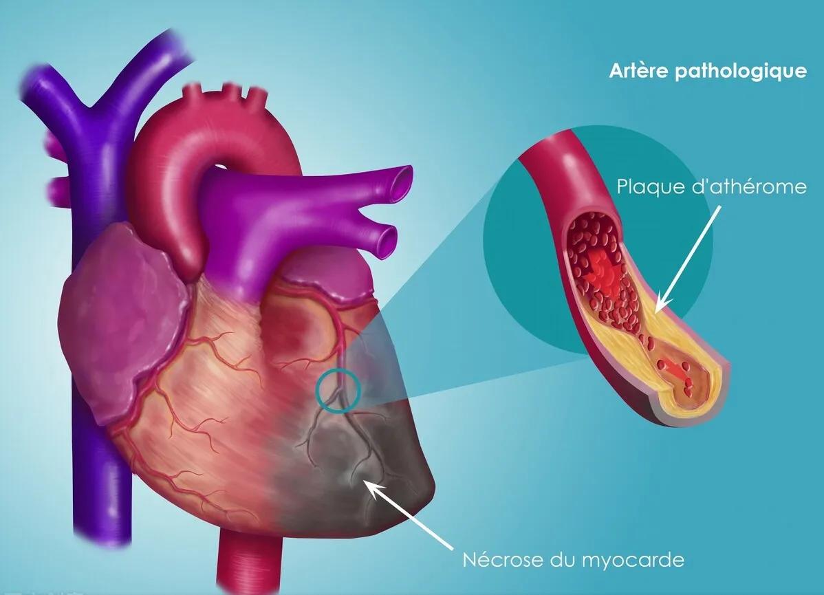 中成药治疗冠脉微循环障碍,冠脉硬化输活血化瘀的药有用吗