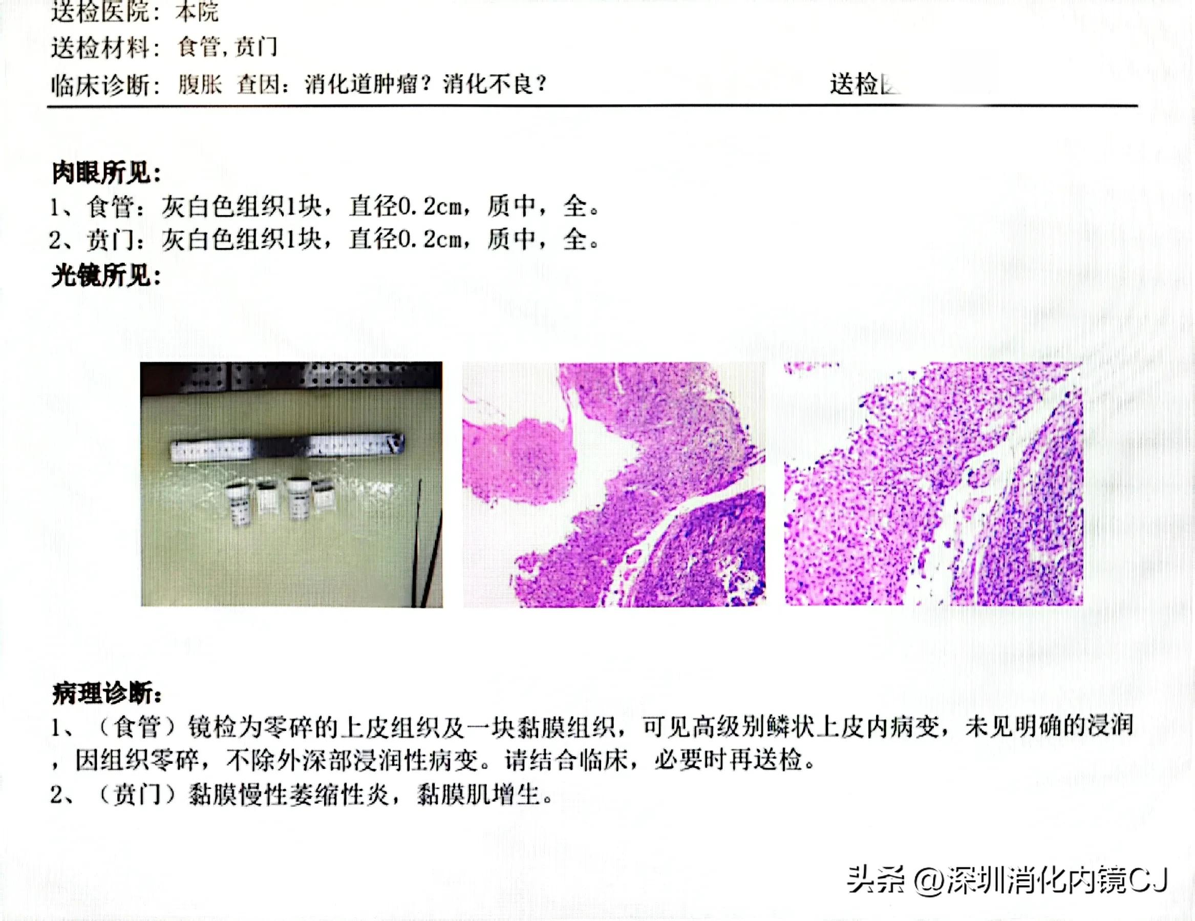 69岁及时发现食管癌，内镜下微创根治，避免了外科开胸手术
