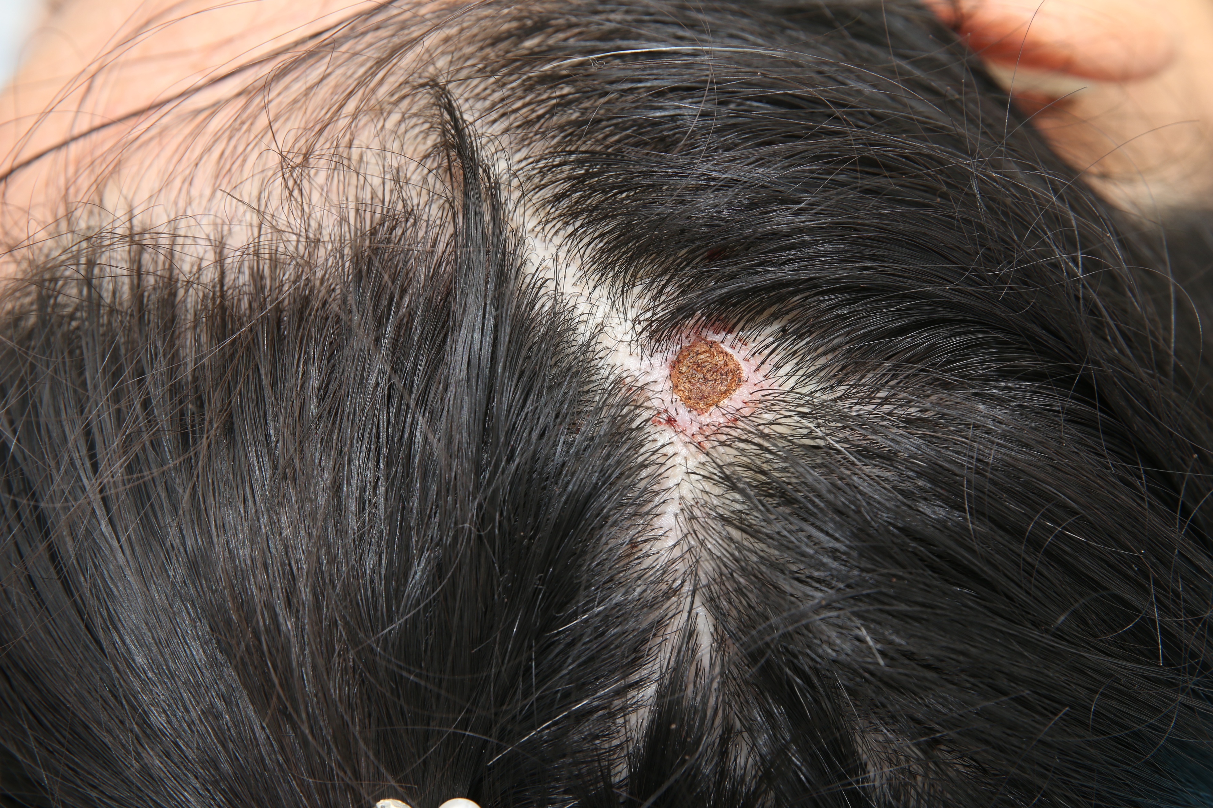 洗头时头皮被抓破了,28岁男子洗头