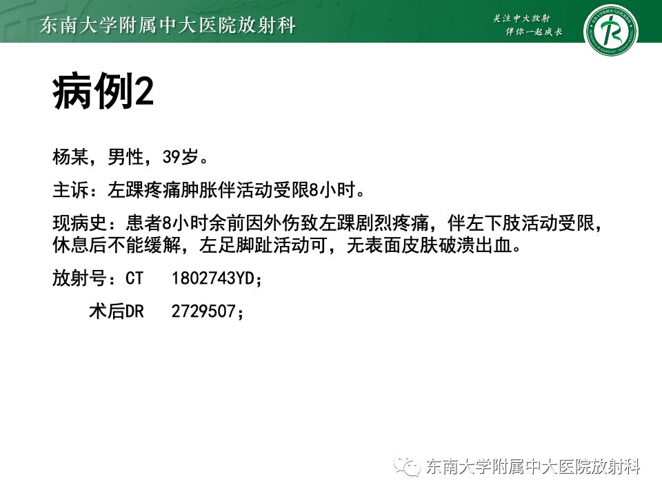 左腓骨下段骨折伴下胫腓联合分离,好文分享深度揭秘