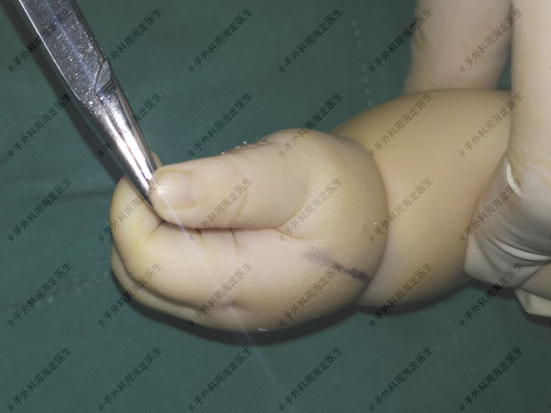 宝宝大拇指伸不直能揉好吗,宝宝大拇指漂浮