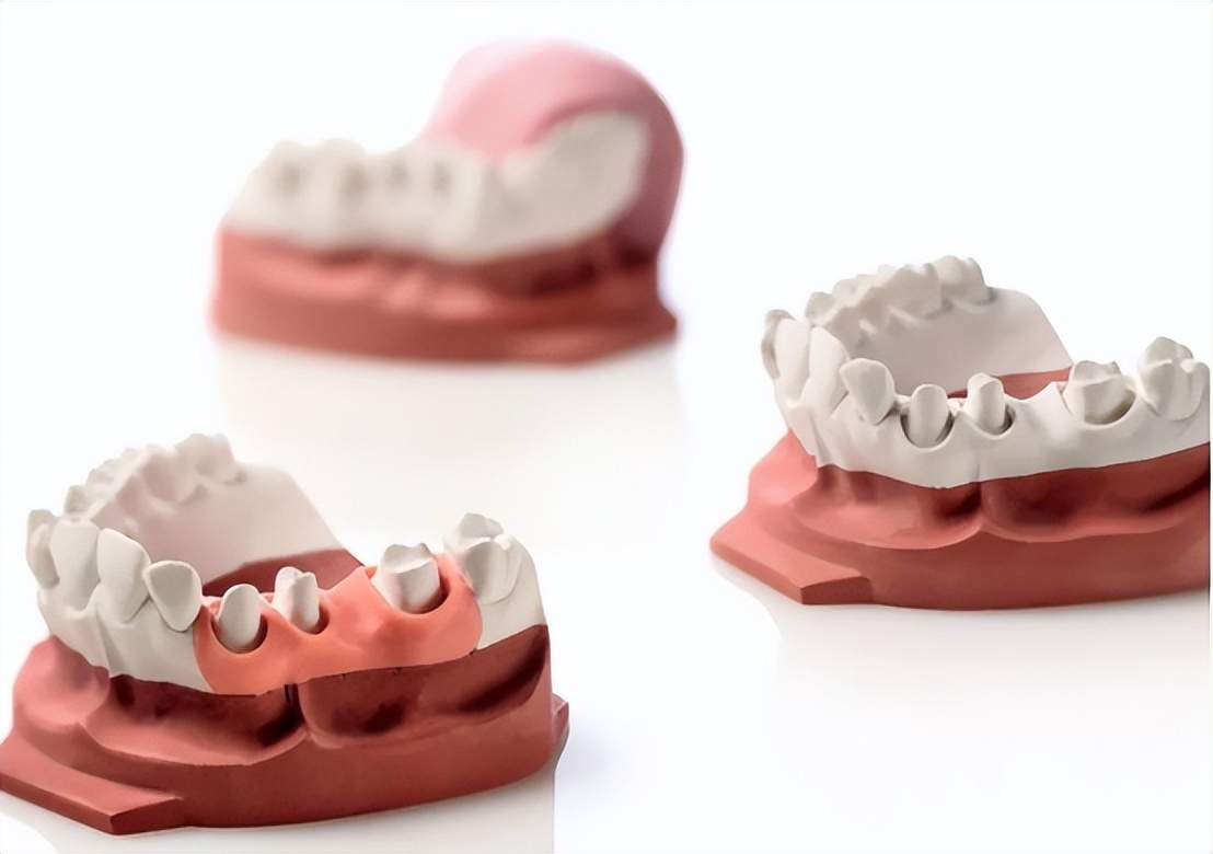 牙龈纤维瘤是肿瘤吗,牙龈纤维瘤会遗传给下一代吗