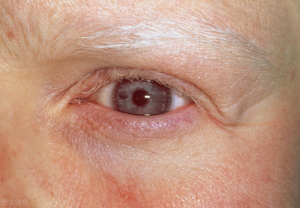 白化病的心理护理,白化病平时都注意哪些事情