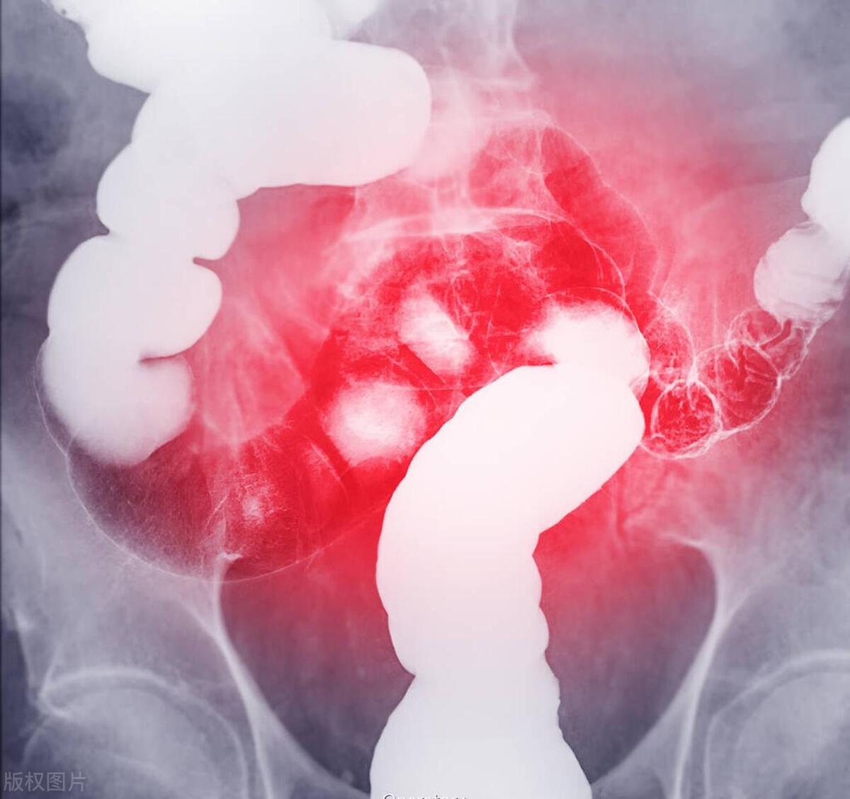 长期不感冒的人，除了免疫力差，还容易得癌？肿瘤医生揭晓真相