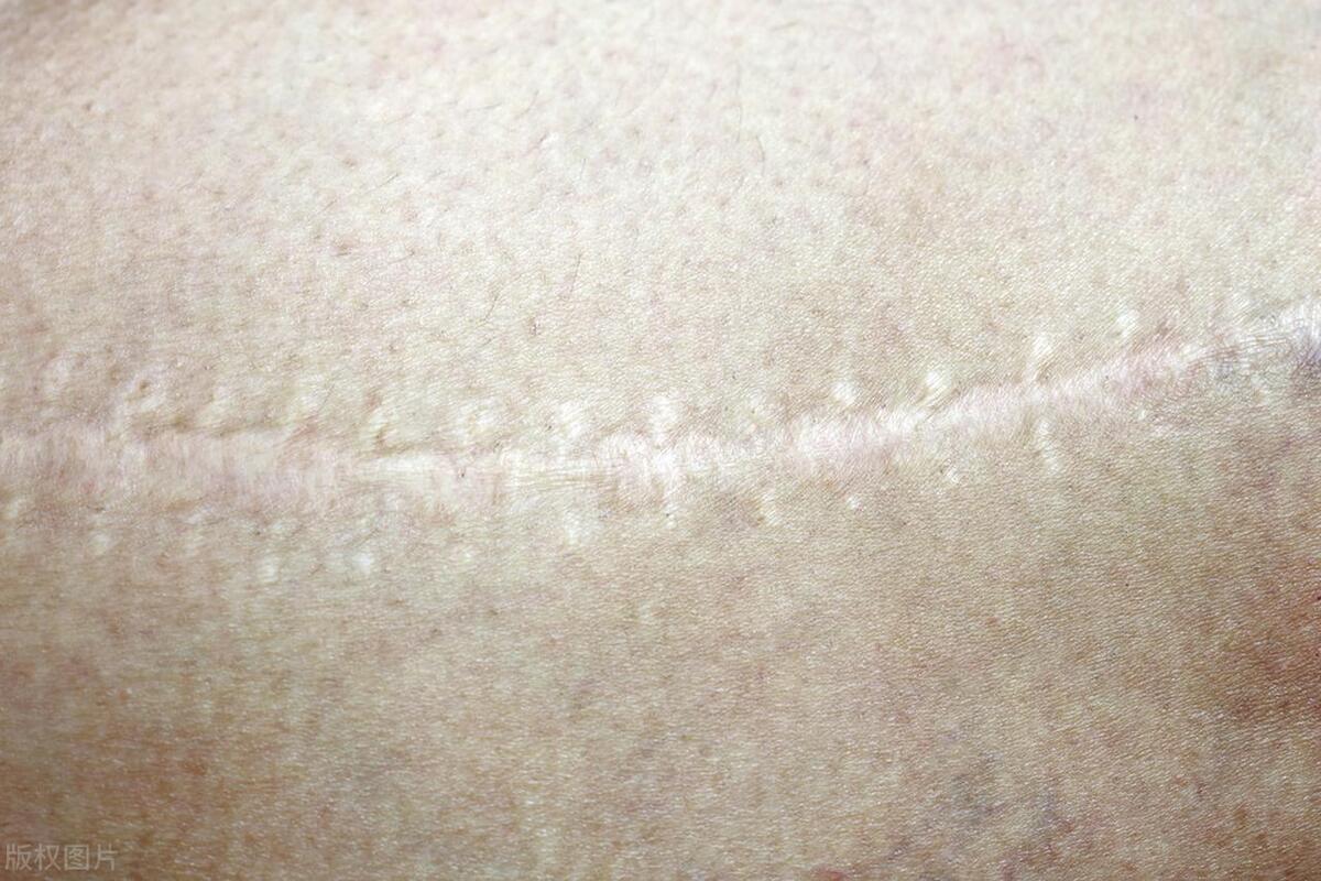 皮肤科激光治疗后需要注意什么,皮肤科手术及治疗有哪些注意事项